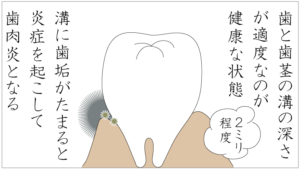 歯周病とは3